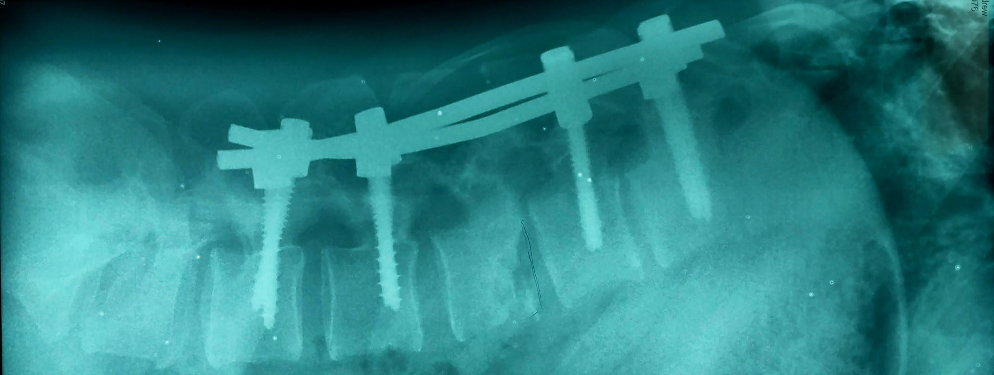 Recovering From a Broken Back A Timeline Hiking Illustrated